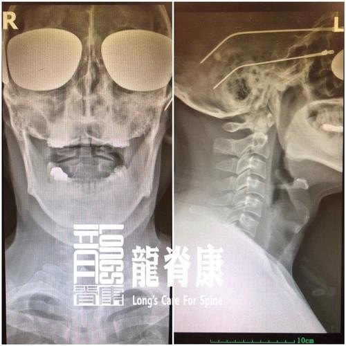 头颅，颈椎ct都没事为啥还头晕呢？