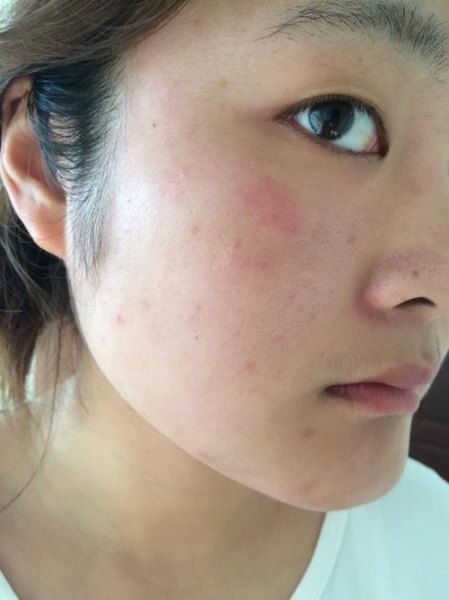 脸部突然发红发烫是怎么回事？