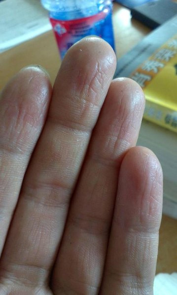 手指的指腹干瘪是怎么回事？