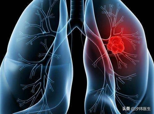 肺癌扩散了只能活三个月吗？