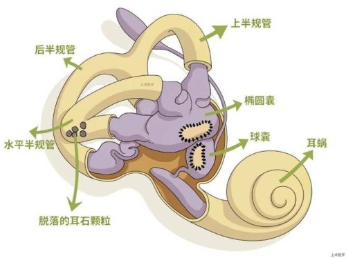 耳石症是由于什么而导致的？