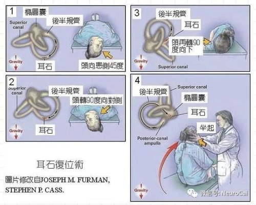 耳石症可以自己在家里复位吗？