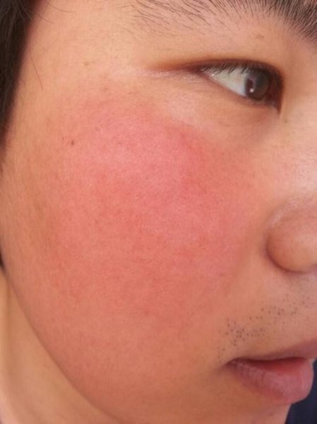 脸部发热发红应该怎么办？