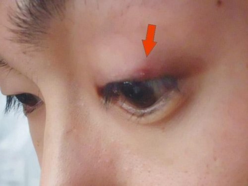麦粒肿手术后三个月依然红肿 麦粒肿手术后三个月依然红肿